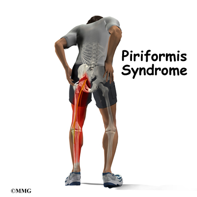 piriformis syndrome • BODY FIRST UK